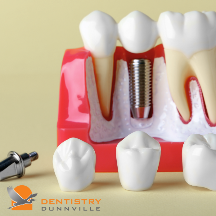 Dental implants and crowns model displayed at Dentistry Dunnville