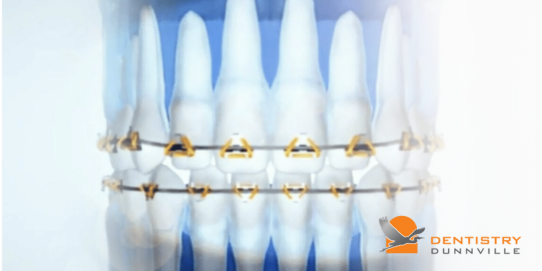 Fastbraces versus traditional braces at Dentistry Dunnville