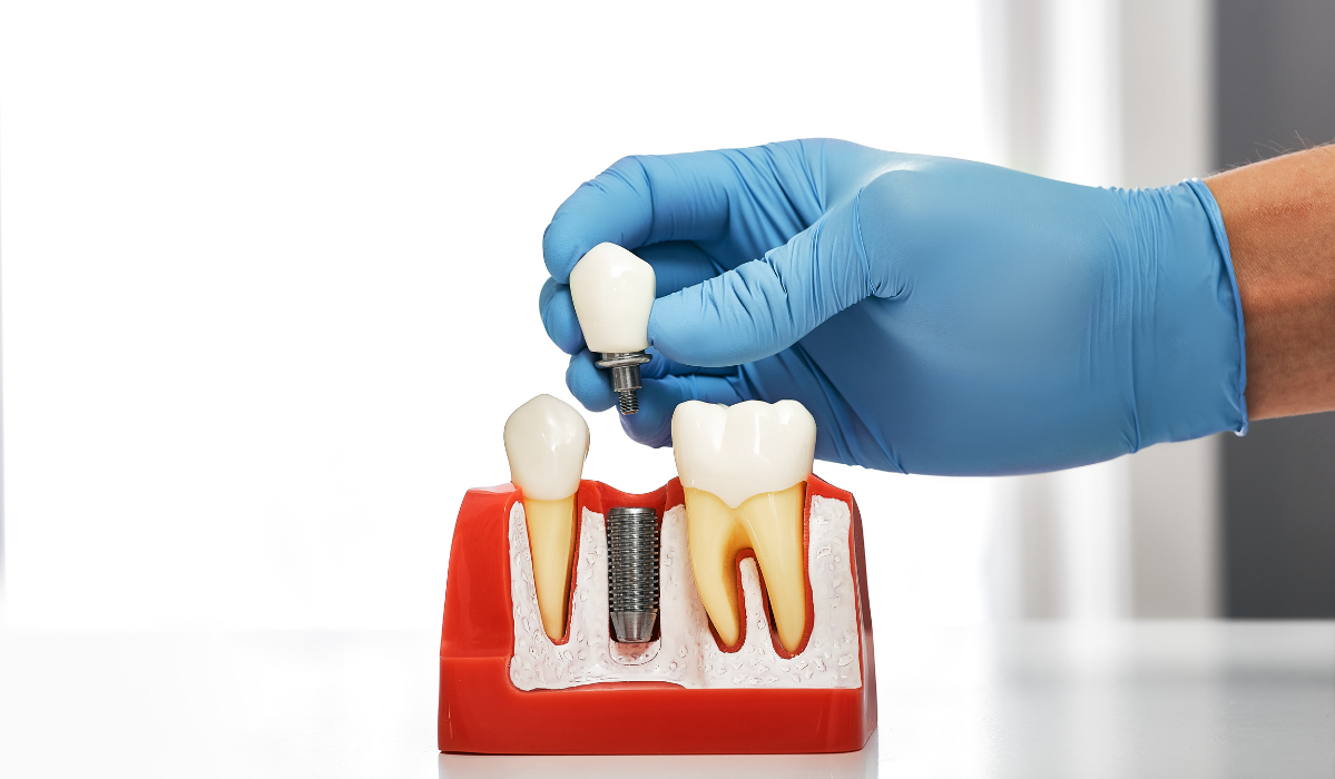 Dental implants comparison single vs multiple at Dentistry Dunnville