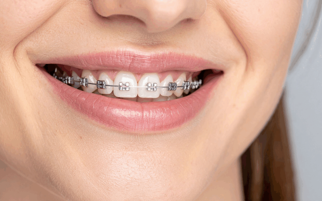 Braces: Foods to Avoid & Safe Alternatives