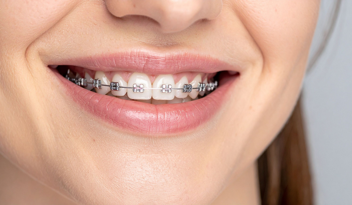 Braces friendly foods and items to avoid at Dentistry Dunnville Braces friendly foods and items to avoid at Dentistry Dunnville