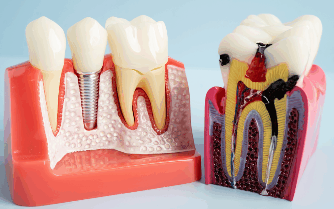 Root Canal Retreatment: When Second Treatment Needed