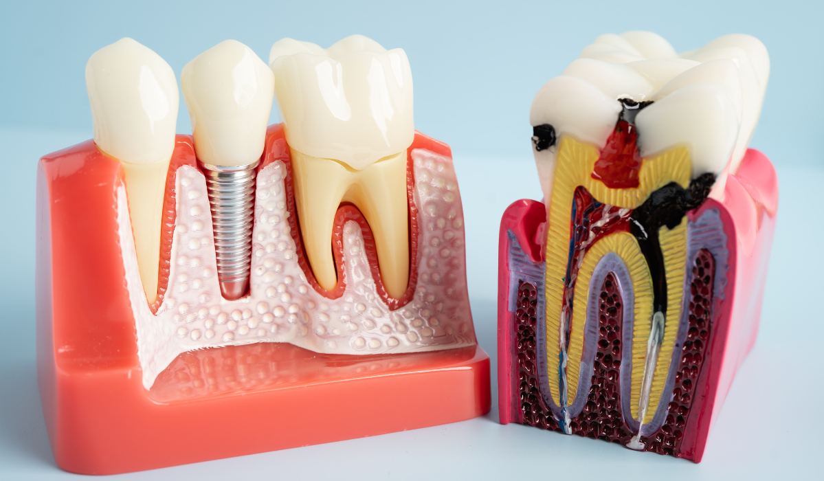 Root canal retreatment procedure explanation at Dentistry Dunnville nov 25 Root canal retreatment procedure explanation at Dentistry Dunnville