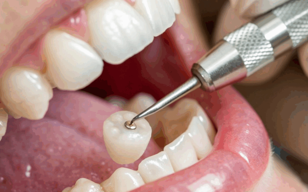 Dentist in Dunnville: Rebuilding Damaged Teeth with Restorative Dentistry