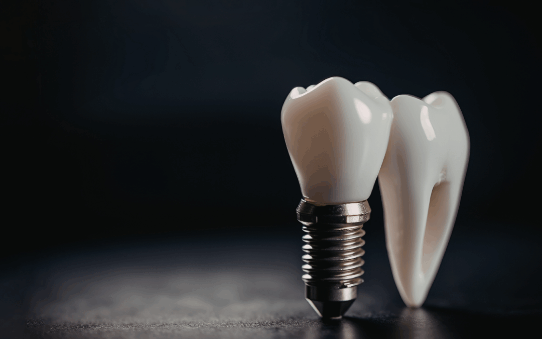 Dental Implants Crown Attachment: The Final Restoration Process