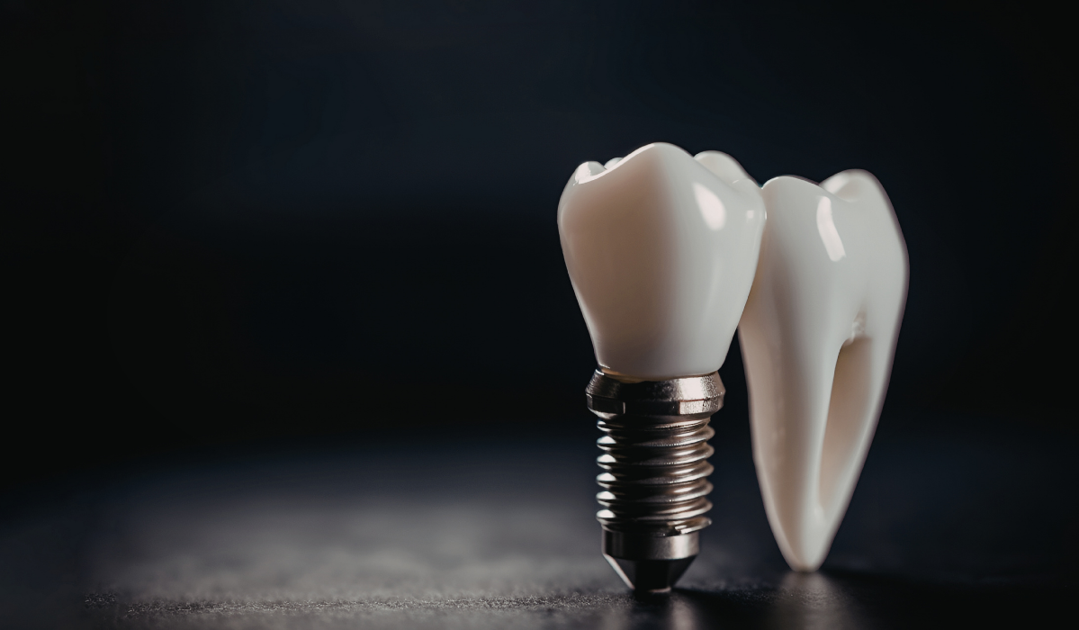Dental implants crown attachment and final restoration process at Dunnville Dentistry Dental implants crown attachment and final restoration process at Dunnville Dentistry