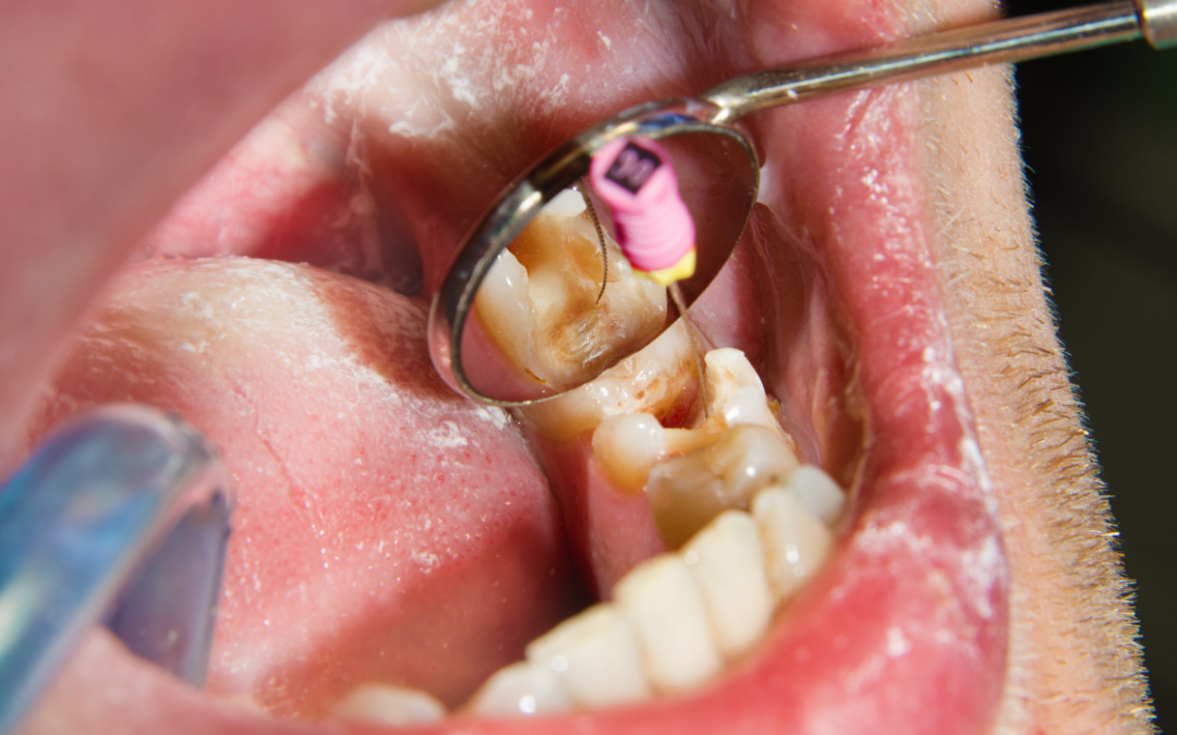 Root Canal Access Preparation: Creating Entry Points for Treatment