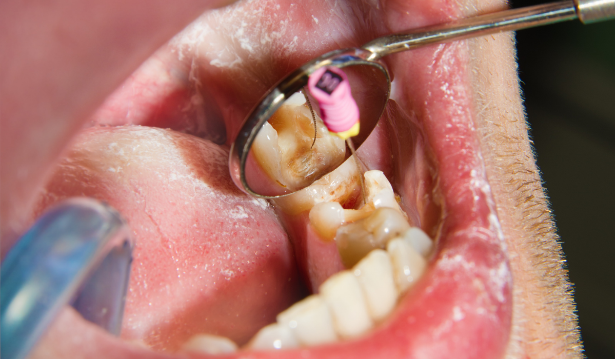 Root canal access preparation process at Dunnville Dentistry