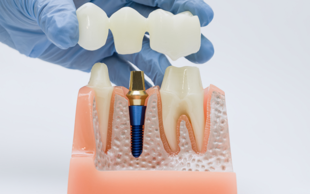 Dental Implants and Gum Health: What You Need to Know