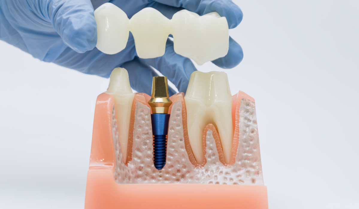 Dental implants soft tissue gum health guide, Dentistry Dunnville