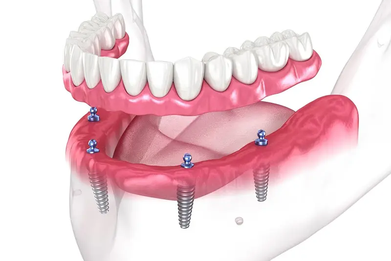 All-on-X in Dunnville implant procedure with sedation at Dentistry Dunnville